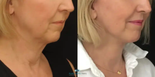 tratamiento de los cordones platismales en el plano profundo de la cara y el cuello