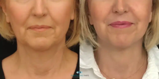 tratamiento de los cordones platismales de cara y cuello plano profundo vista frontal