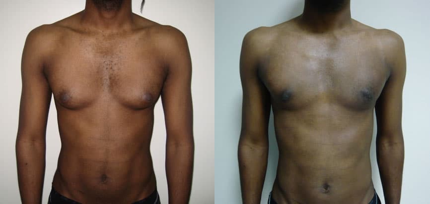 Male gynecomastia