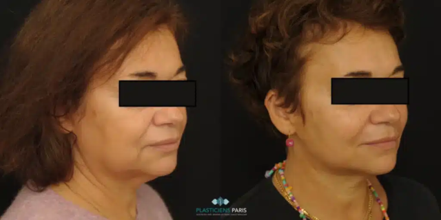 lifting cervical pure en deepl plane avec lipofillinf facial travil sur l'oval et l'aspect du cou restauration des volumes du visage