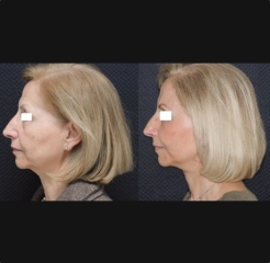 Lifting cervicofacial de doble plano de una mujer. Vista lateral. Resultado de un lifting cervicofacial de doble plano con suspensión SMAS, lipofilling de pómulos, blefaroplastia de los 4 párpados. Vista lateral. Mejora de la papada y del surco nasogeniano.