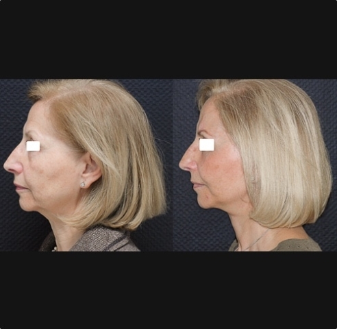 Lifting cervico-facial double plan d'une femme. Vue de profil. Résultat d’un lifting cervico-facial double plan avec suspension du SMAS, lipofilling des pommettes, blépharoplastie des 4 paupières. Vue de profil. Amélioration de la bajoue et du sillon naso-génien.