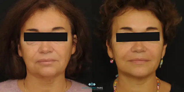 lifting cervico facial blepharoplastie des 4 pupieres et lipofilling facial restauration des volume et restauration v shape visage