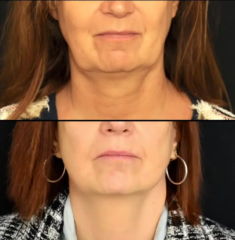 lifting facial y de cuello plano profundo tratamiento de la papada
