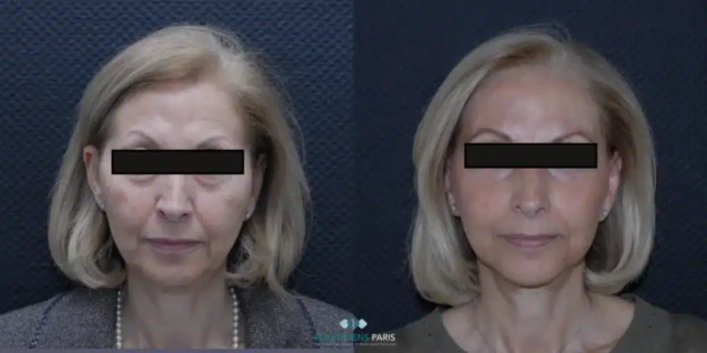 جراحة شد عنق الرحم وشد الوجه وشد الجفون الأربعة وحشو شفاه الوجه استعادة حجم وشكل الوجه v
