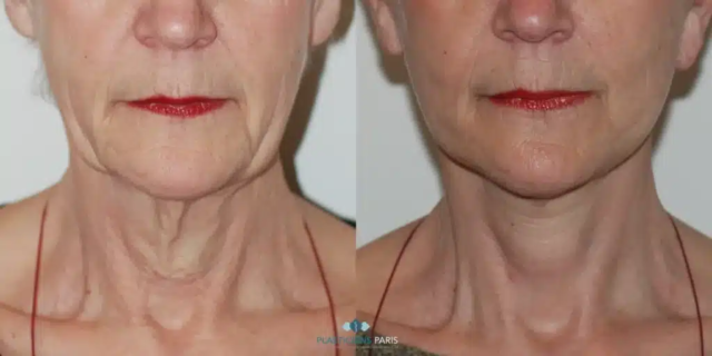 lifting d'une femme vue de face