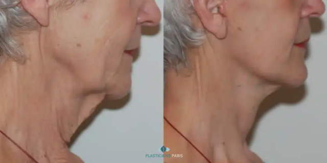 lifting cervico facial d'une femme avec travail sur les muscle et le relachement cutané peau mature
