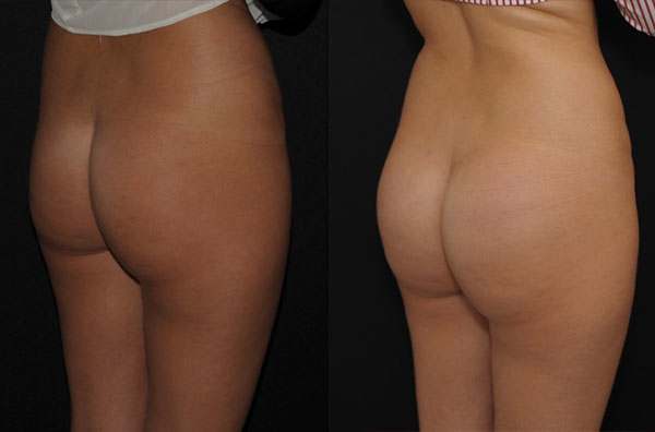 Implants fessiers femme 360 cc résultats vue 3/4