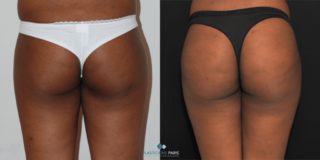 Implantes de glúteos de una mujer resultados vista frontal