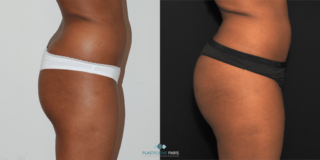 Implantes de glúteos. Foto de resultados de perfil.