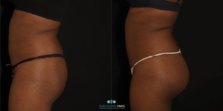 Implantes de glúteos. Foto de resultados de perfil.