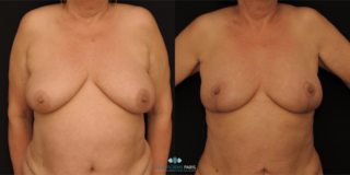 correction of breast ptosis - front view
