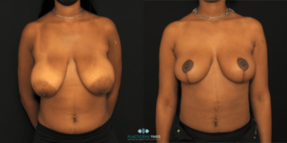 correction of breast ptosis - front view