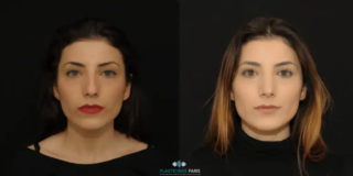 Rinoplastica ad ultrasuoni con trattamento della punta per affinarla e rimozione del gibbo - vista frontale