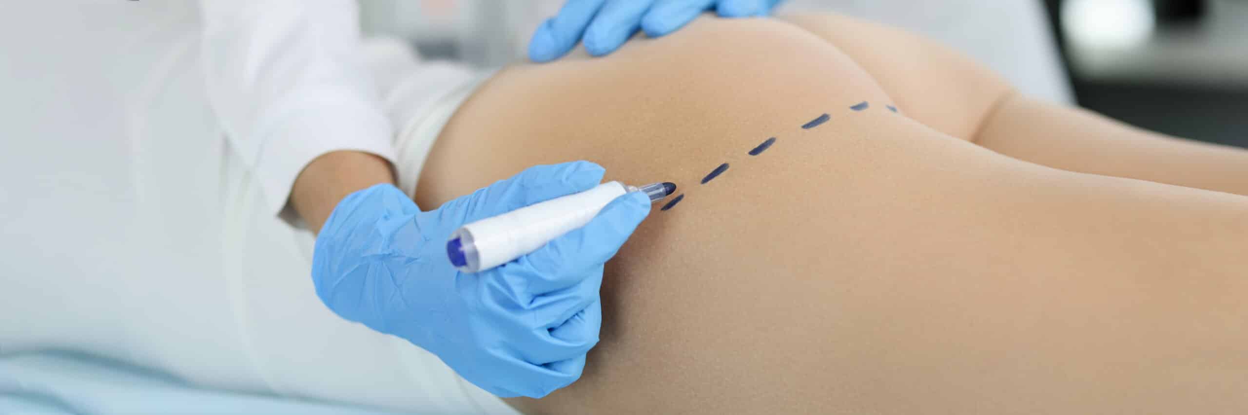 Les implants fessiers