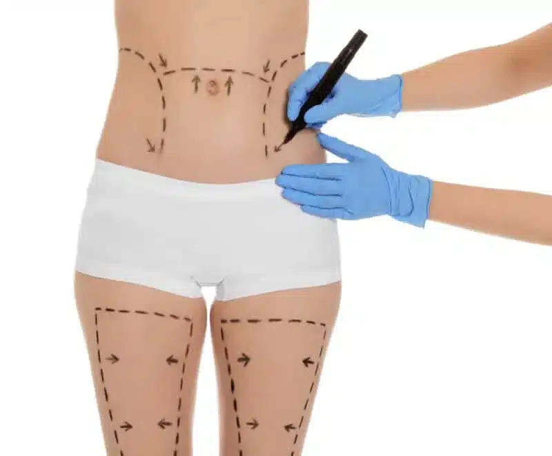 prix d’une liposuccion price of liposuction