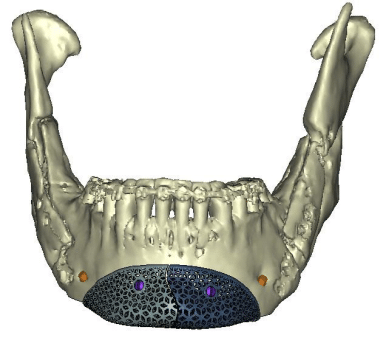 这是定制的多孔钛植入物的扫描图像，该植入物用于隆下巴或进行颏成形术。