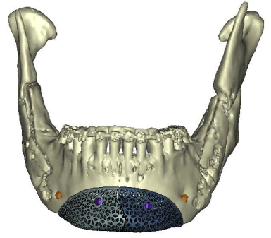 Il s'agit d'une image scanner d'un implant sur mesure en titane poreux réalisé pour une augmentation de menton ou mentoplastie