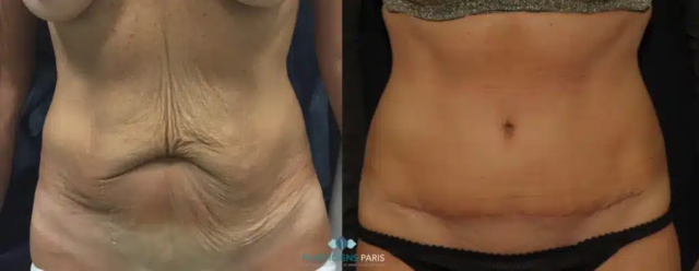 plastie abdominale post amaigrissement important, lifting cutané avec points de hautre tension, cicatrice pouvant âtre cachée par la culotte