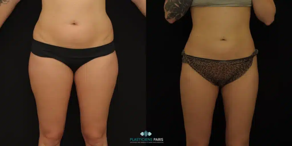 liposuccion du ventre des hanches et des cuisses femme