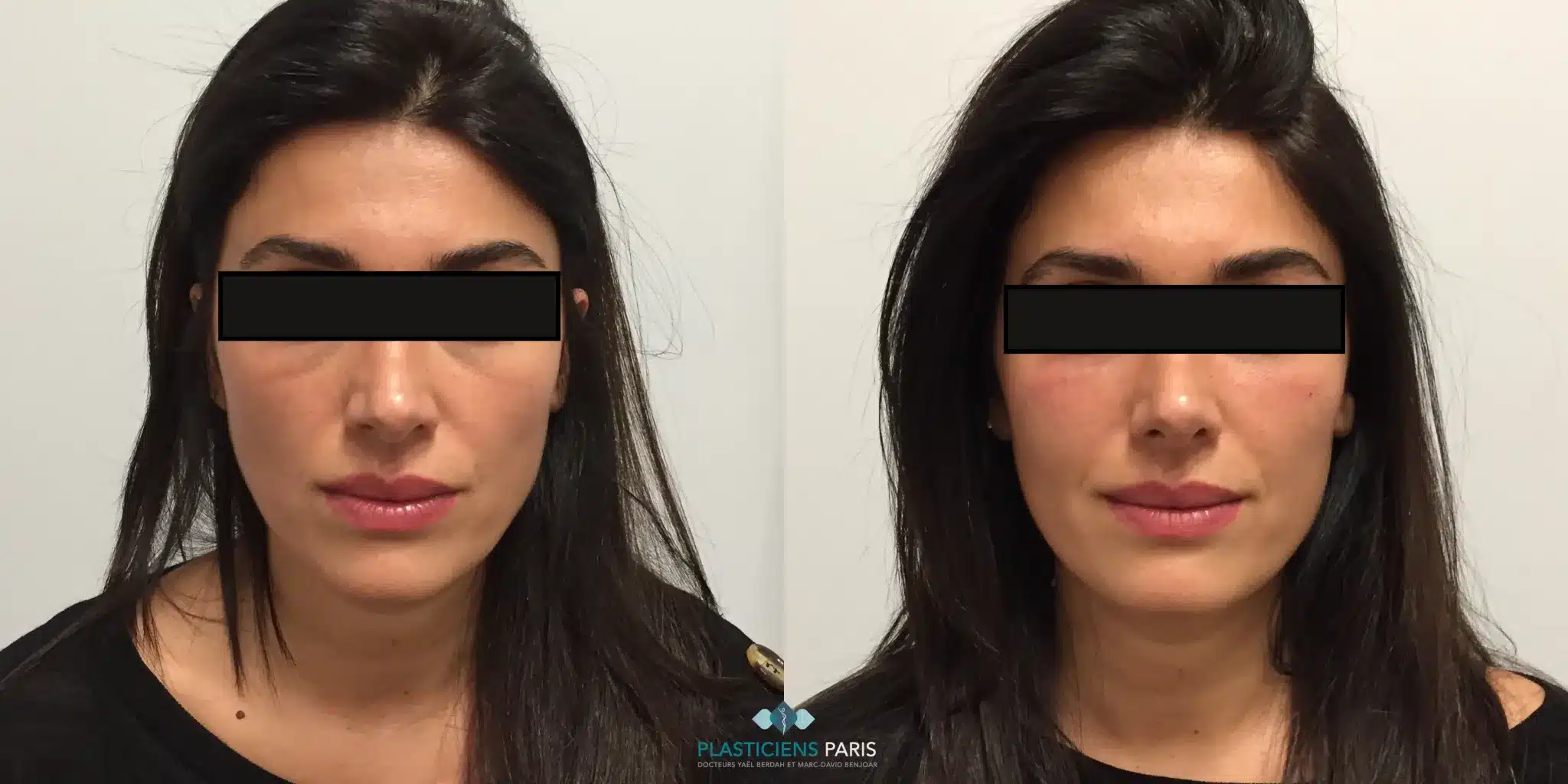 Injection des lèvres par acide hyaluronique