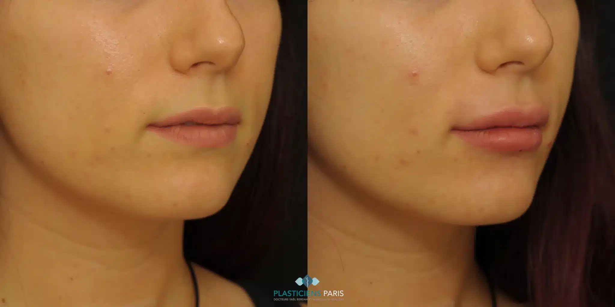 Injection des lèvres par acide hyaluronique