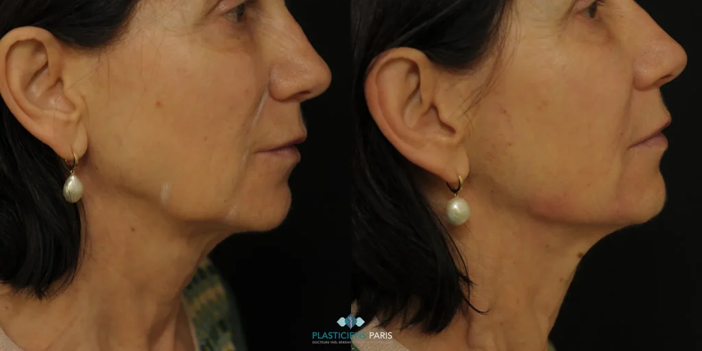 injection acide hyaluronique jawline avant après
