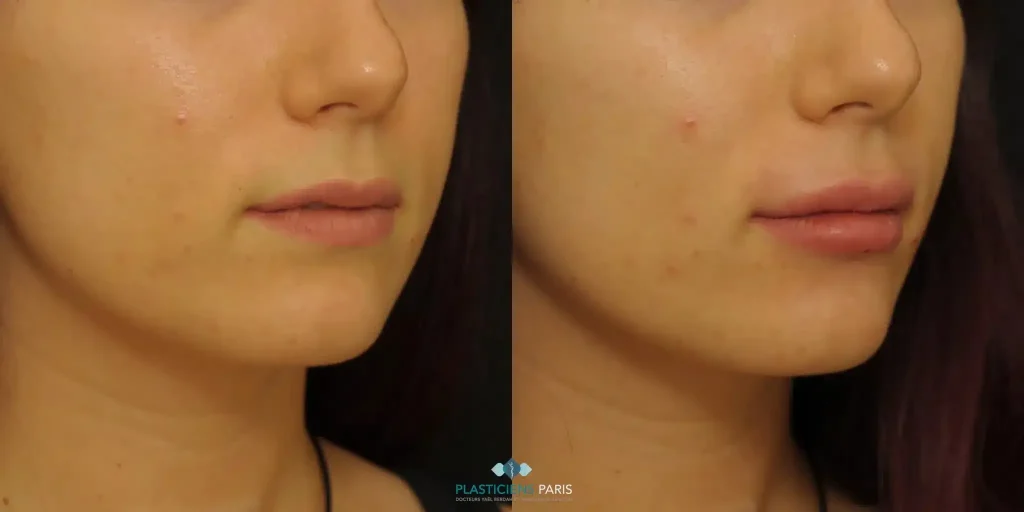 injection acide hyaluronique visage photos avant après