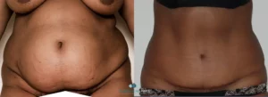 remboursement abdominoplastie