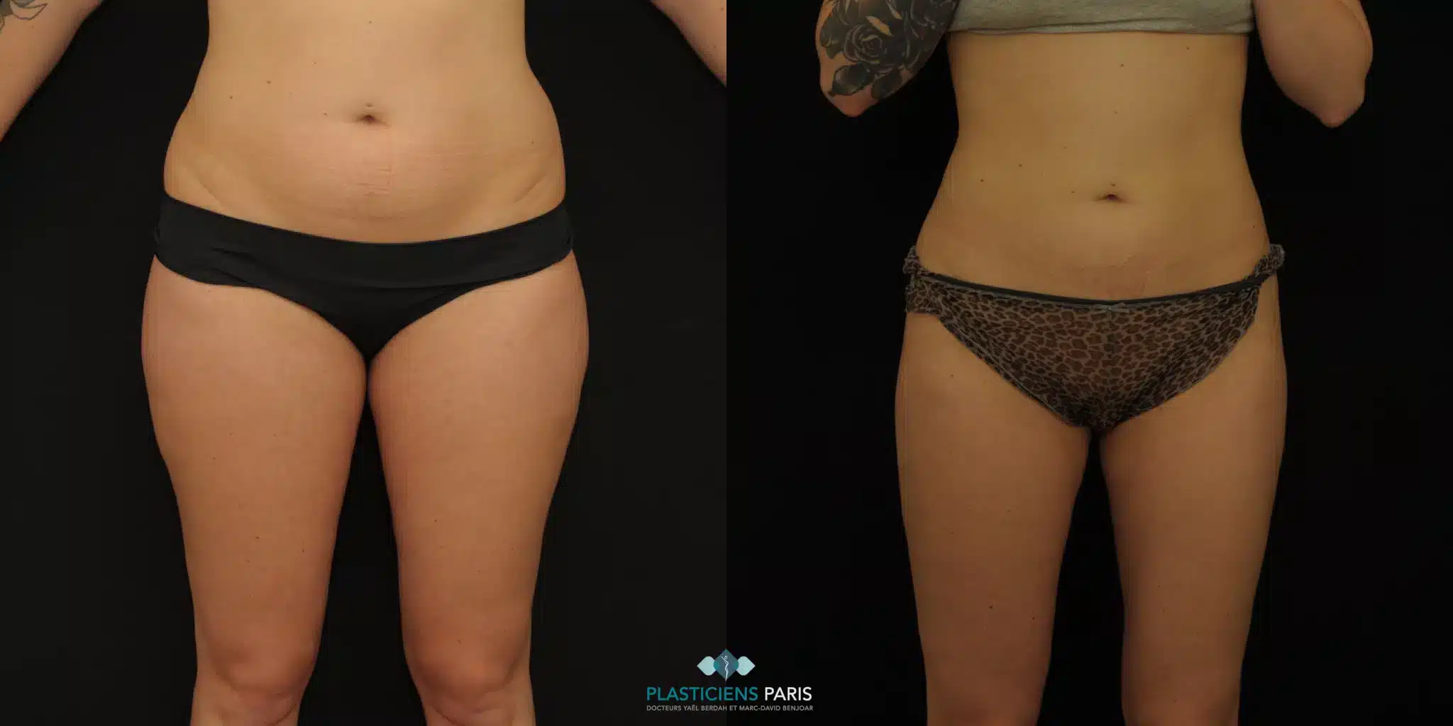 liposuccion des cuisses avant après