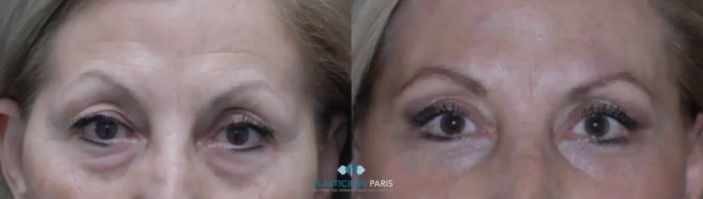 Blépharoplastie avant après