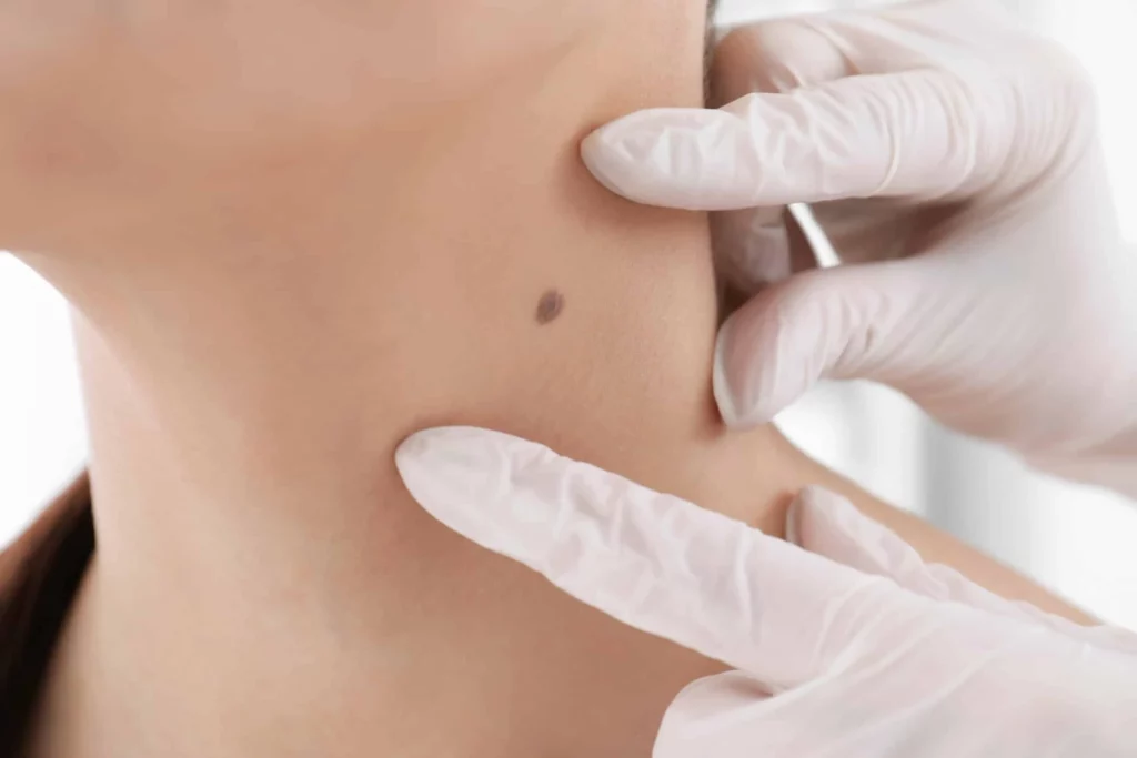 Chirurgie cutanee Reconstruction faciale apres cancer