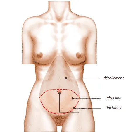 Abdominoplasty schema
