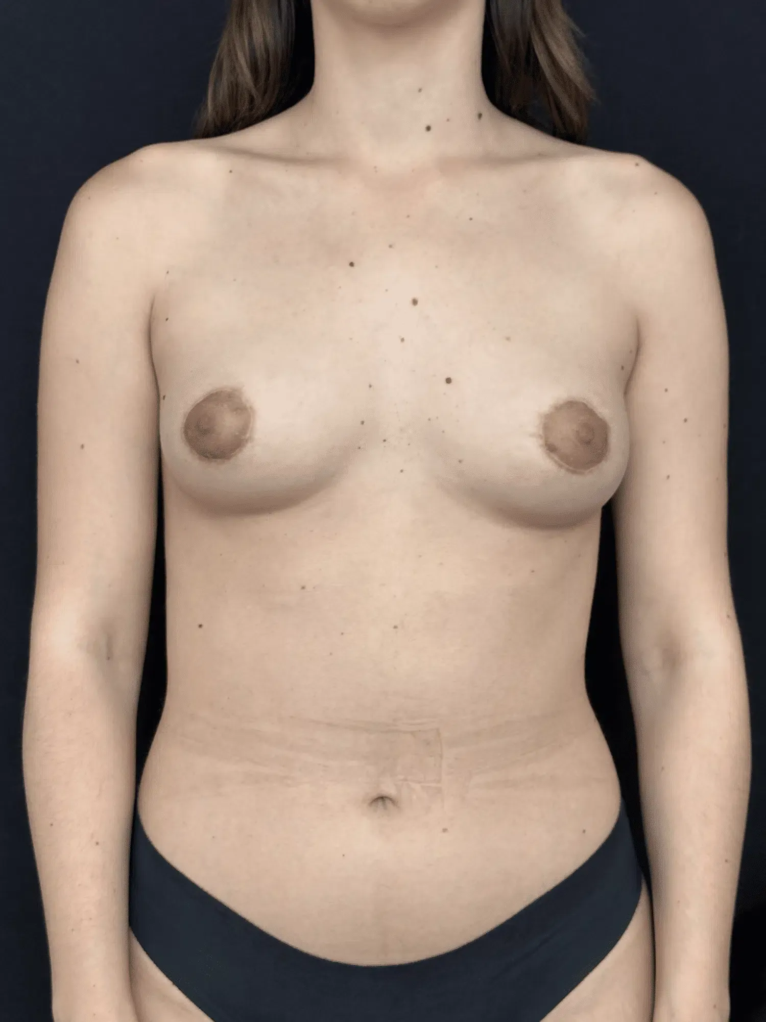 Tuberous Breasts – After (Front View)