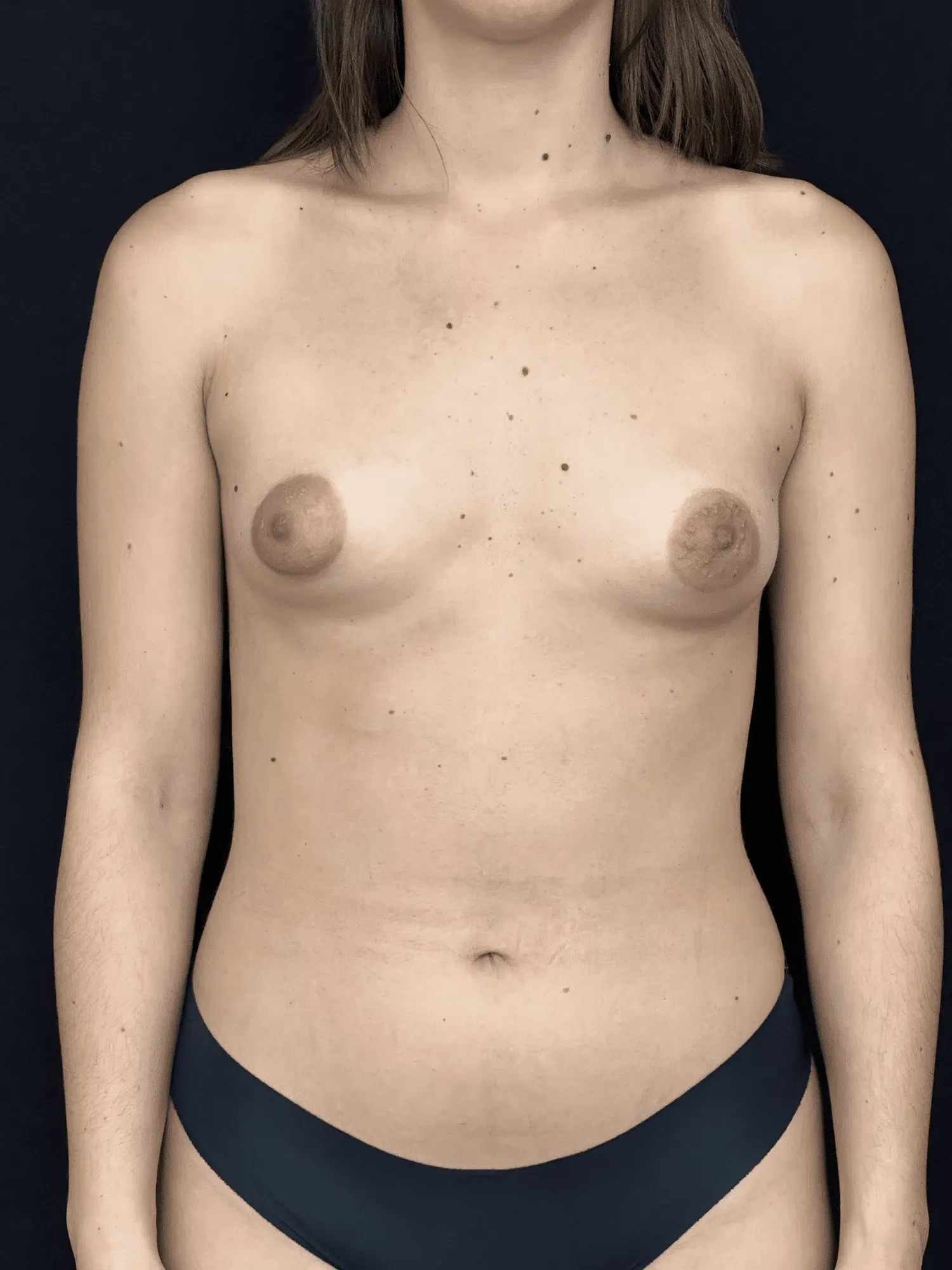 Tuberous Breasts – Before (Front View)