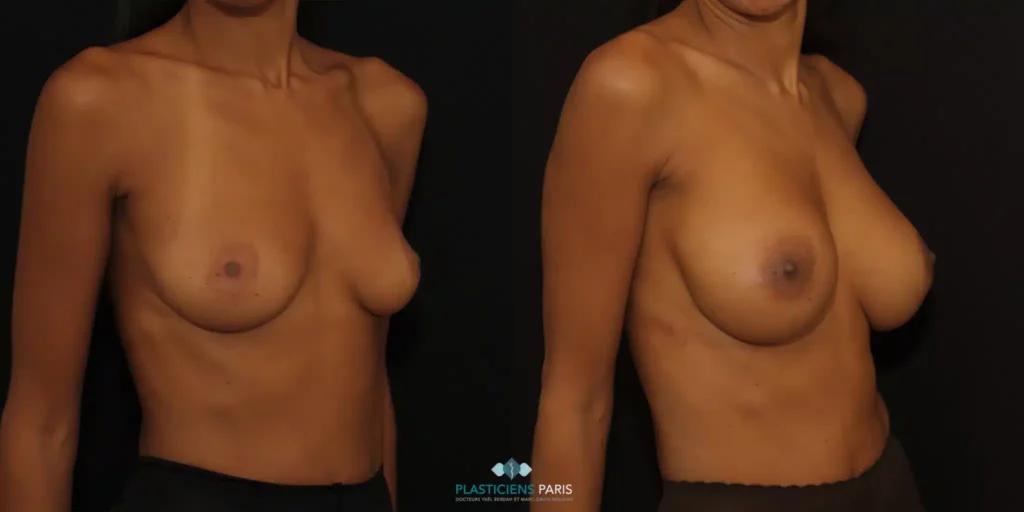 augmentation mammaire avant après