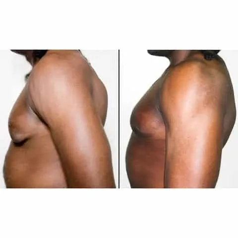 avant apres gynecomastie hernie areolaire