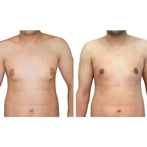 avant apres gynecomastie