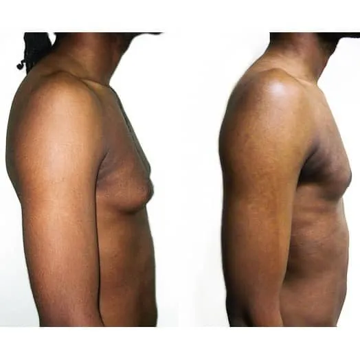 avant apres gynecomastie