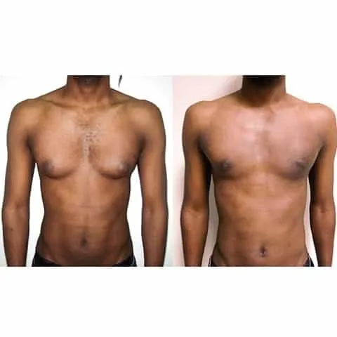 avant apres gynecomastie