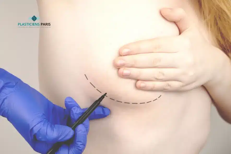 chirurgie mammaire apres un cancer du sein