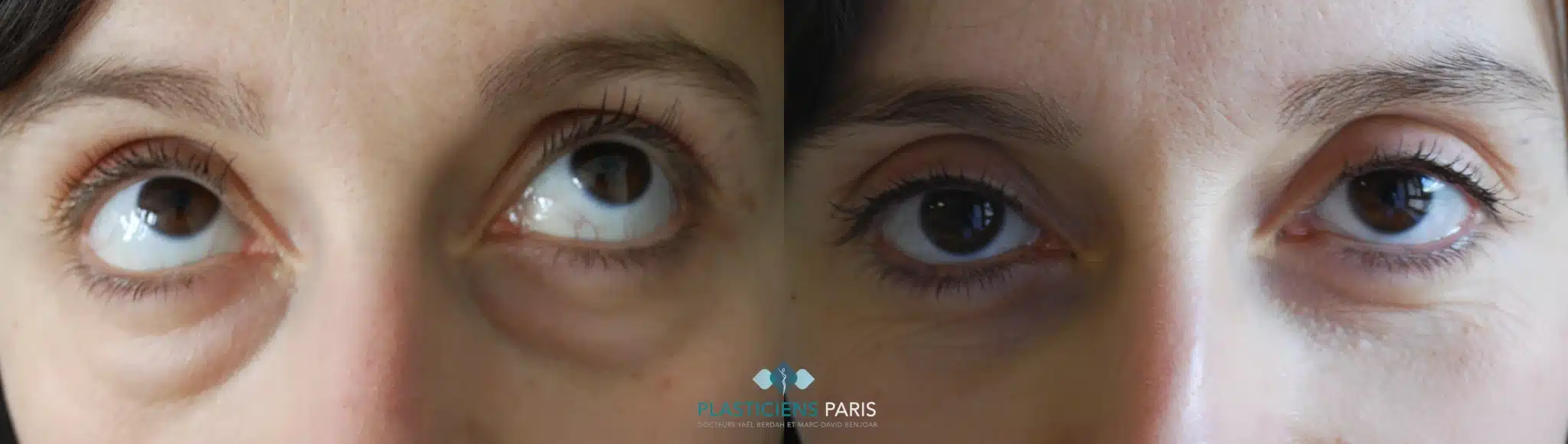 chirurgie des paupieres .png