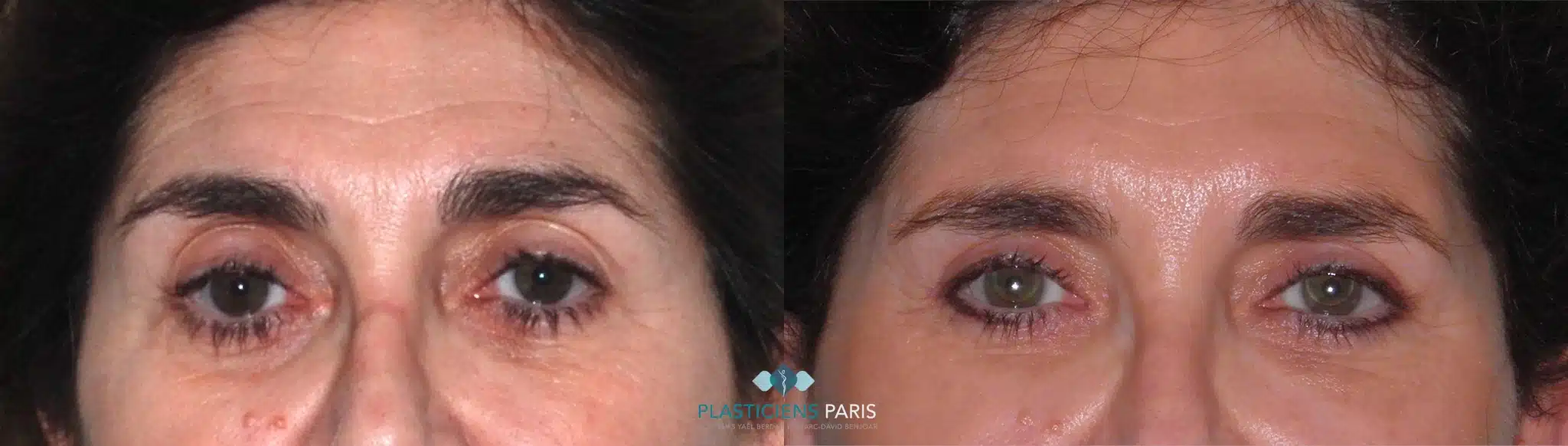 chirurgie des paupieres .png