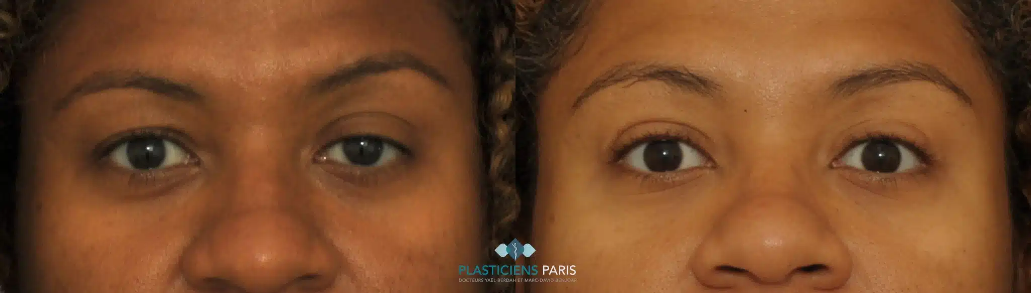 chirurgie des paupieres .png