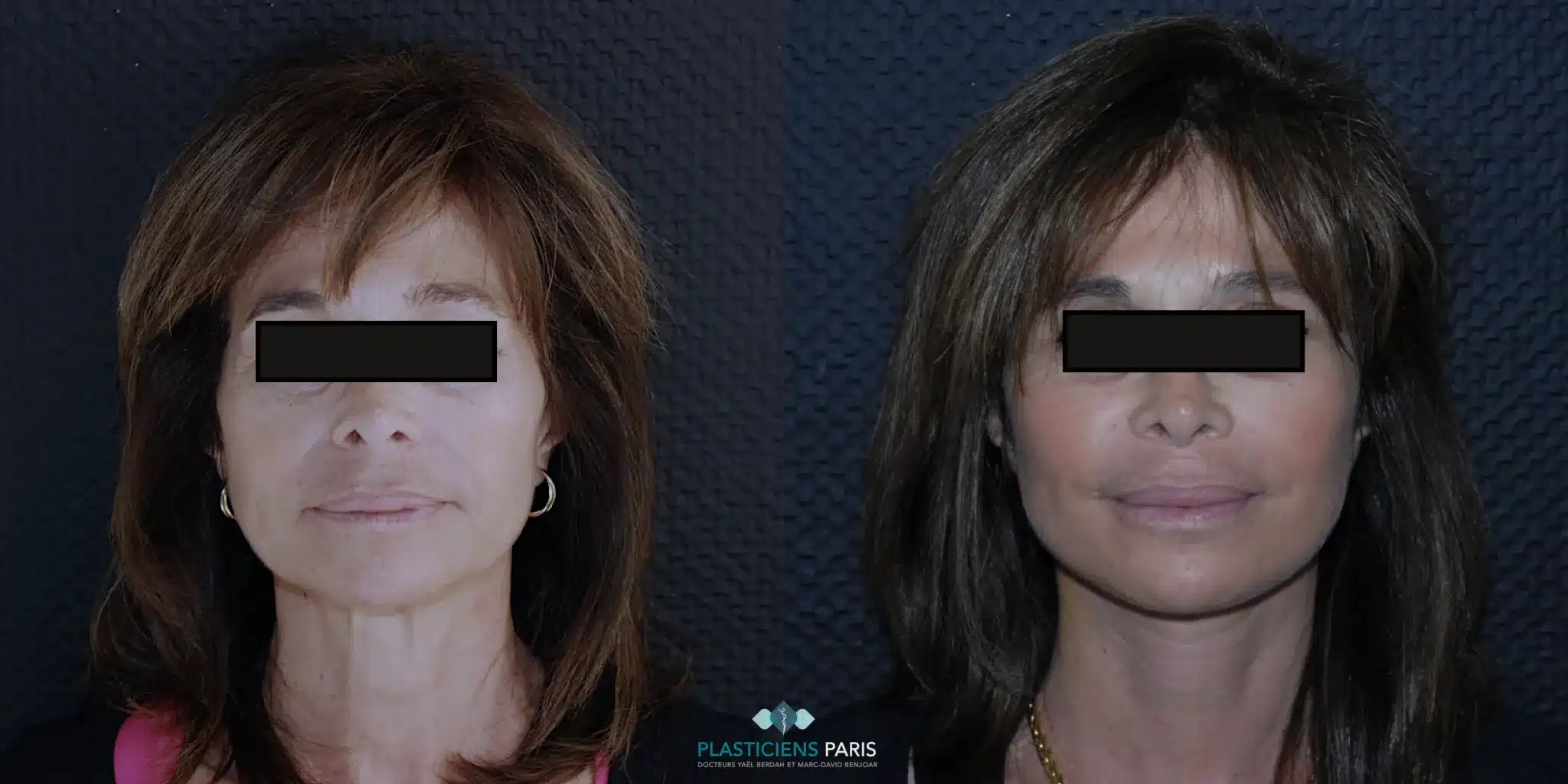 deep plane face lift travail sur loval les cordes platysmales et le cou et angle de la mandibule association a un lipofilling facial restauration des volumes et eclat de la peau