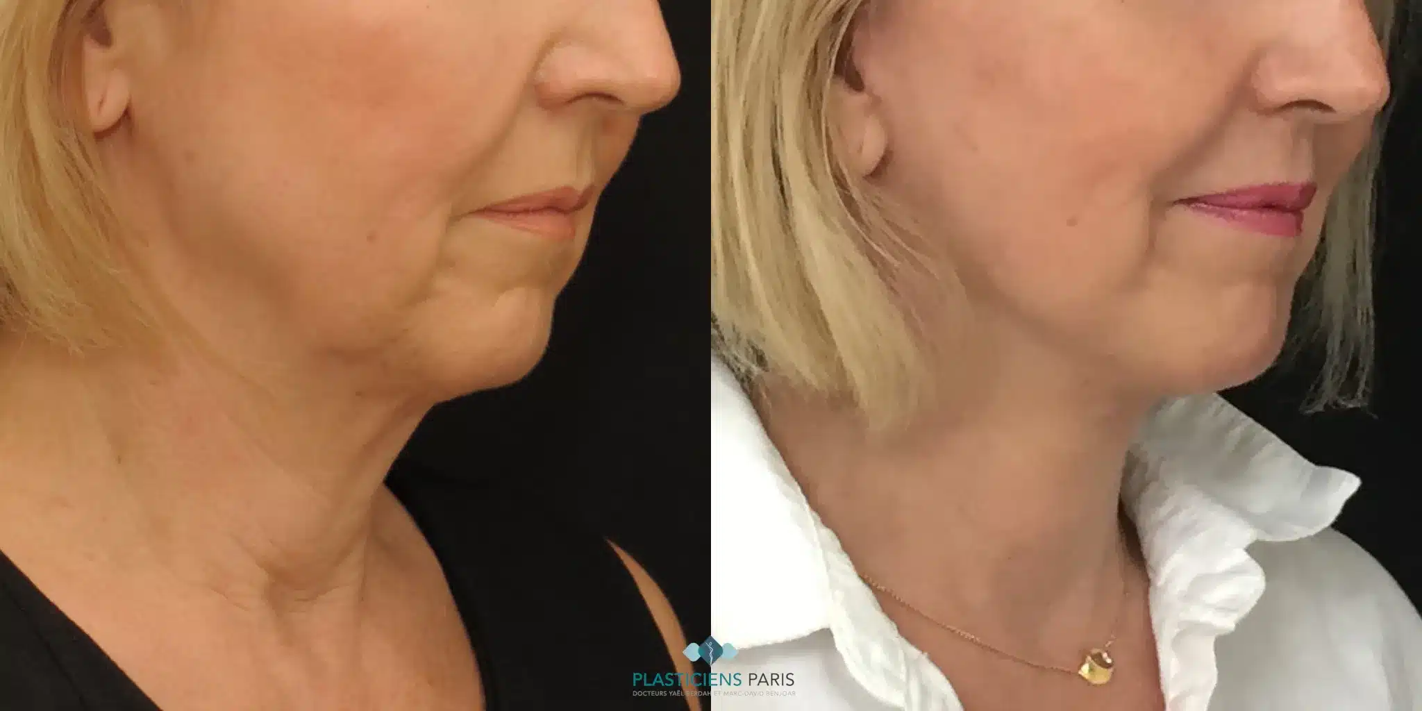 deep plane visage et cou remise en tension de loval et du cou traitement des cordes platismales