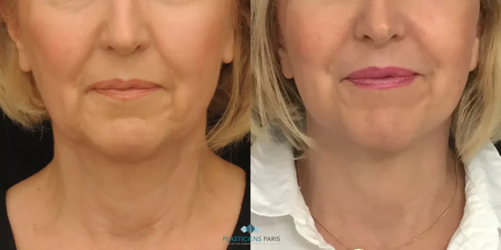 lifting cervico facial avant après