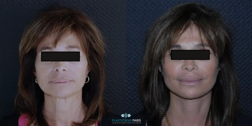 lifting du visage et du cou avant après