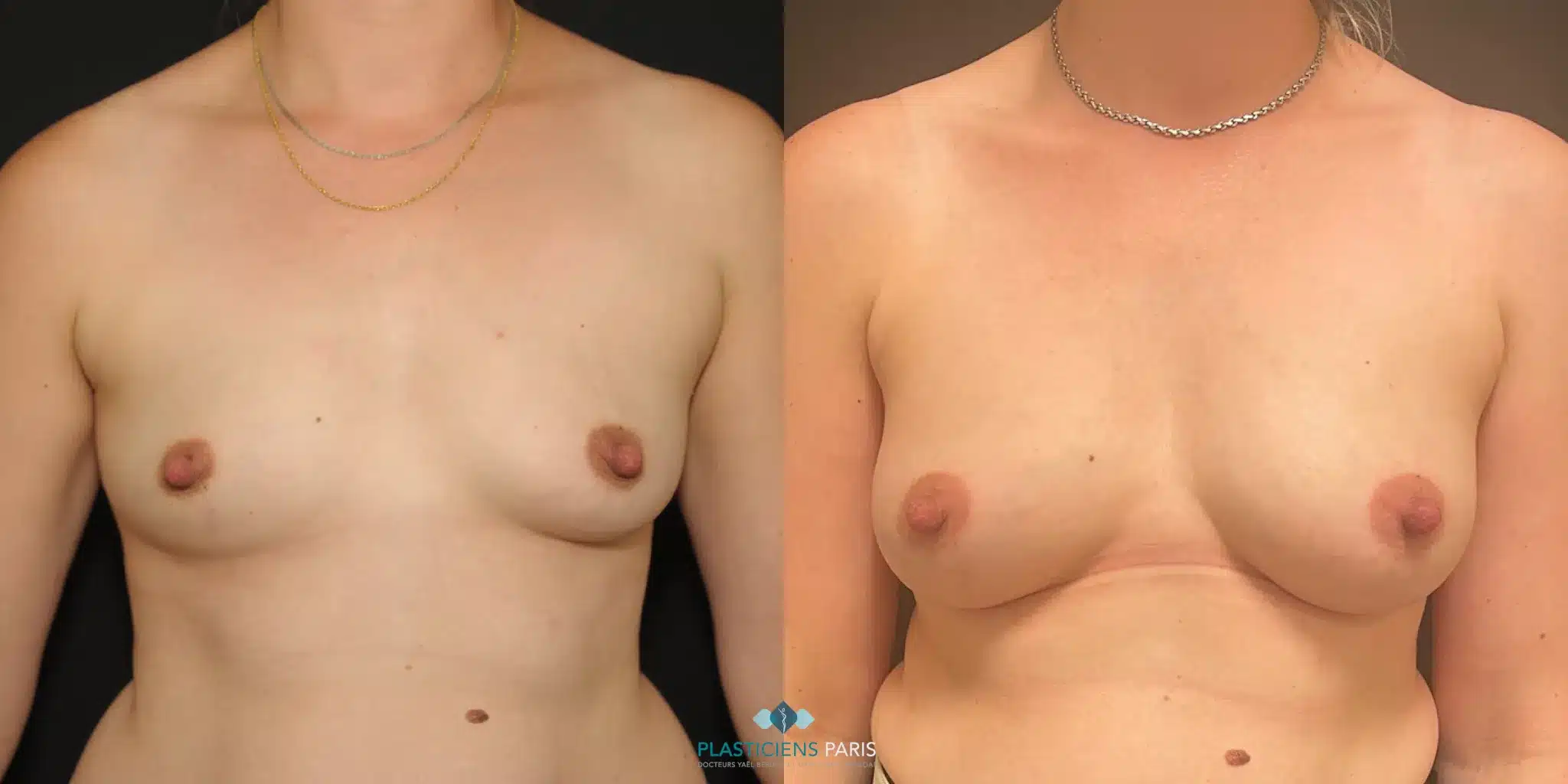 lipofilling mammaire pour augmentation mammaire simple resultat apres une injection.png