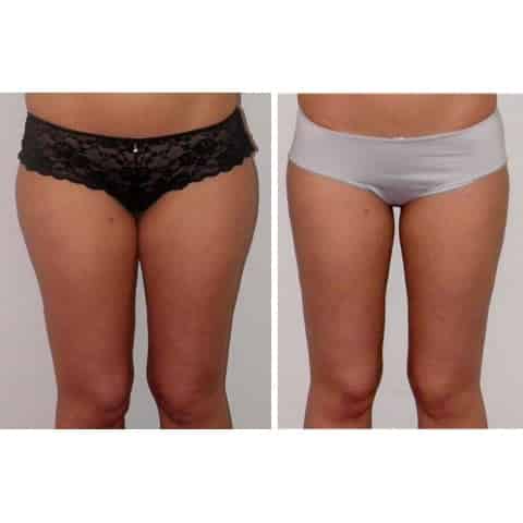 liposuccion cuisses